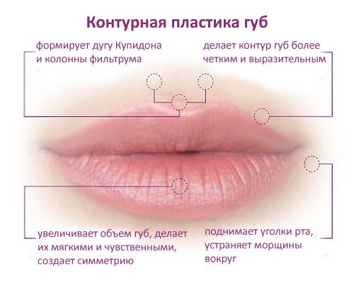 Увеличение губ препаратами на основе гиалуроновой кислоты