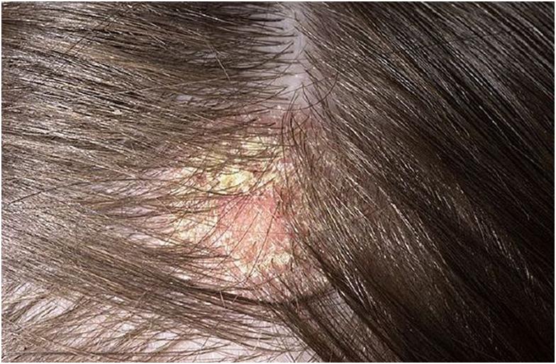 Себорея волосистой части головы: причины, проявления, лечение | HappyDerm